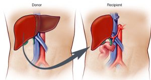 11-month-old child’s successful liver transplant at TU Teaching Hospital