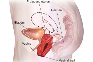 Uterine prolapse is still a concern for women in Nepal. They need more awareness of it