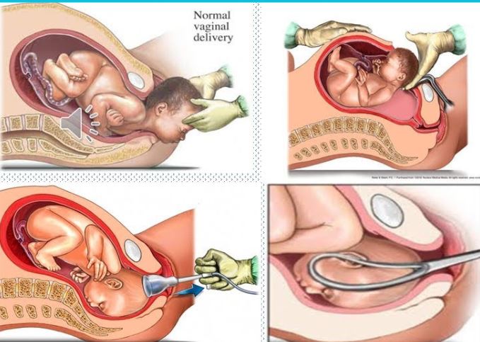 The evolution of childbirth: Exploring spontaneous, vacuum/forceps, and cesarean section deliveries