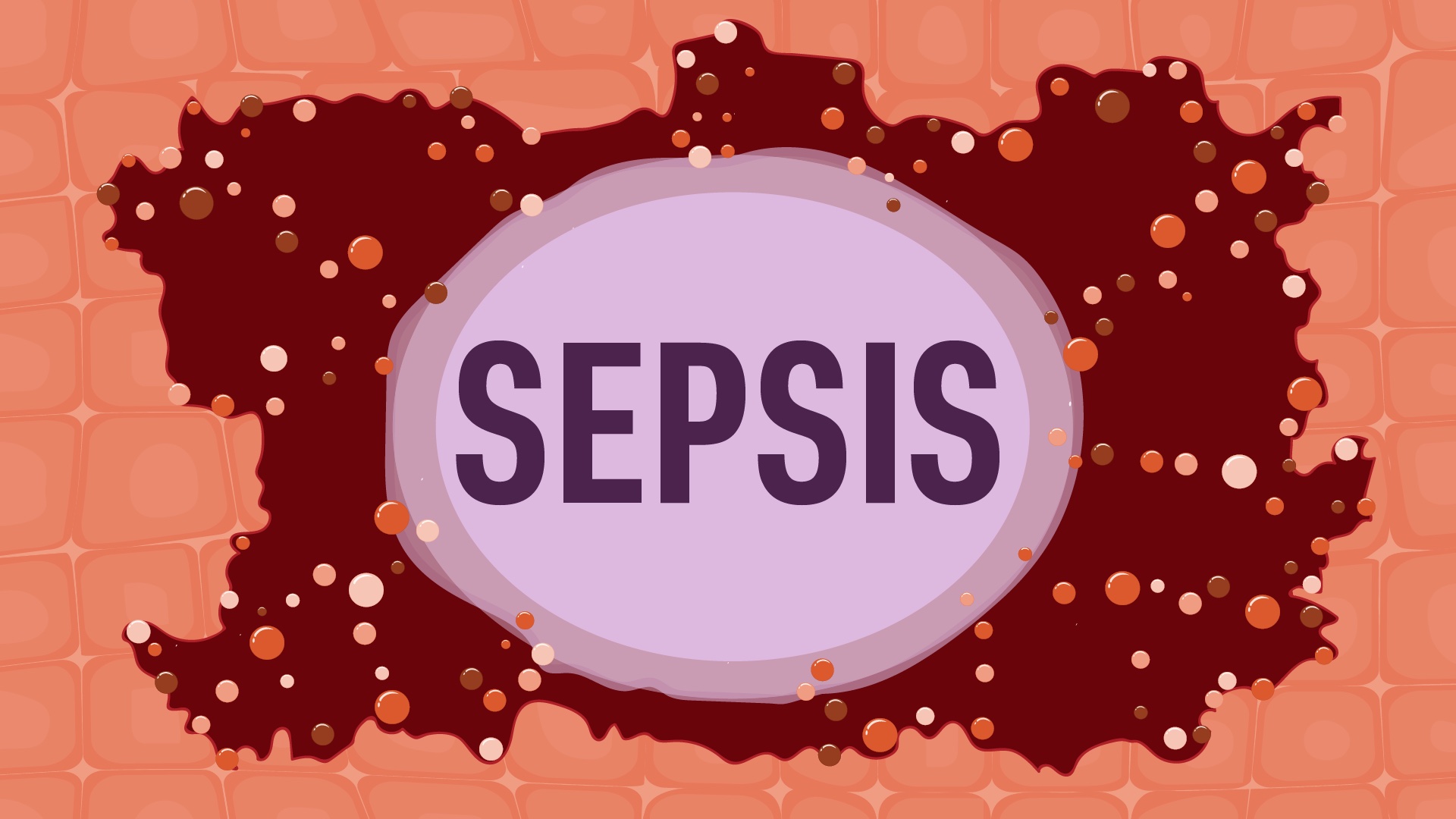 Sepsis and its challenges in Nepal