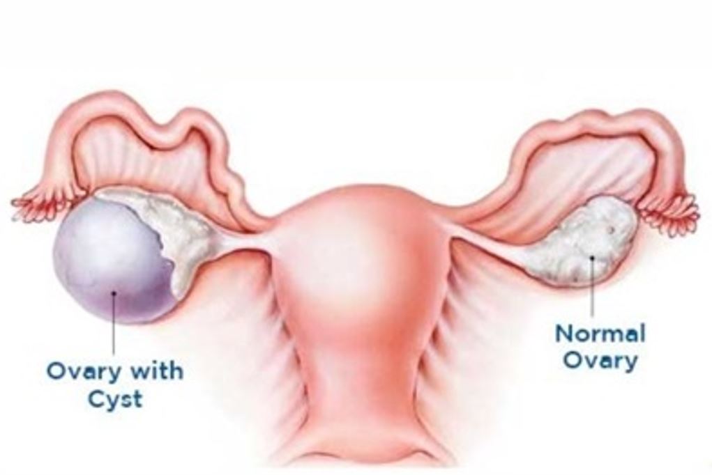 Ovarian cysts: Key facts, symptoms, and treatment options